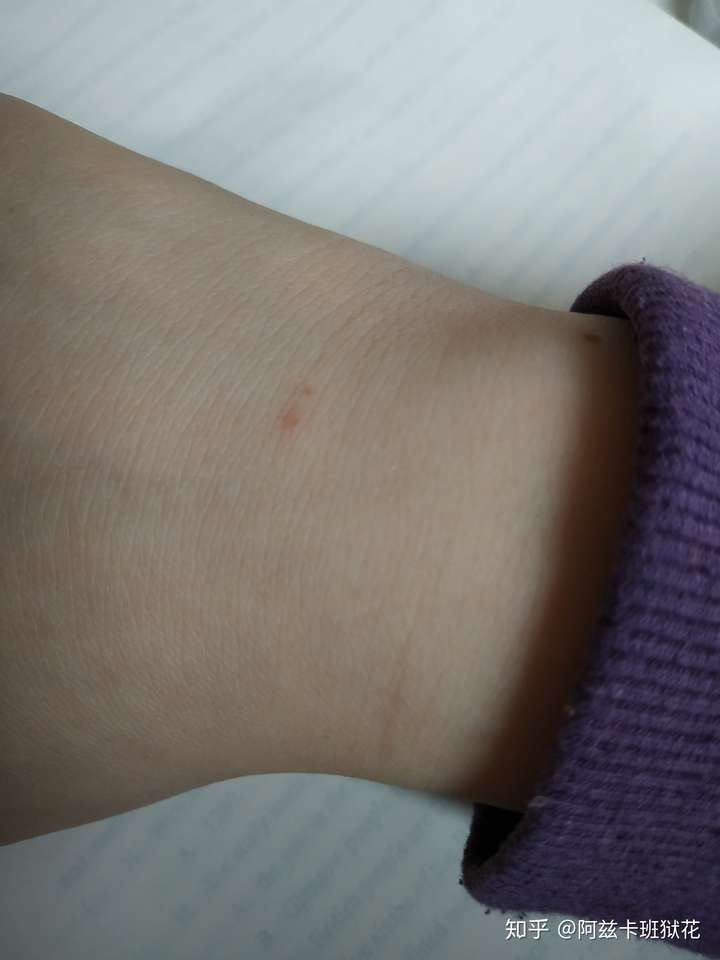 一觉醒来发现胳膊上有两个小针眼是被蝙蝠咬的吗?