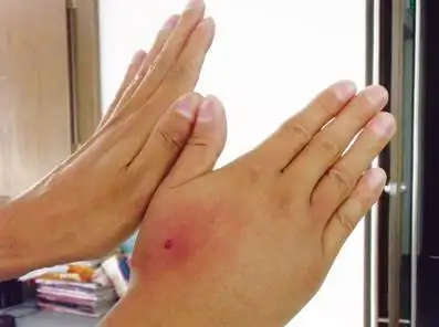 如果不小心被黄蜂蜇伤,首先要仔细检查伤口,如果马蜂的尾刺还在伤口里