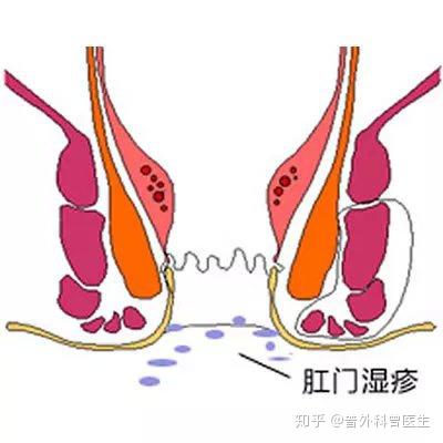 肛周湿疹总是反反复复怎么样都治不好医生告诉你好办法