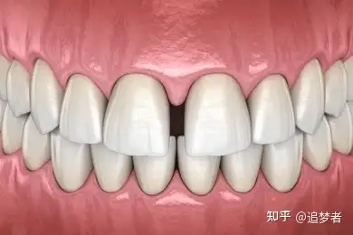 门牙牙缝越来越宽怎么办