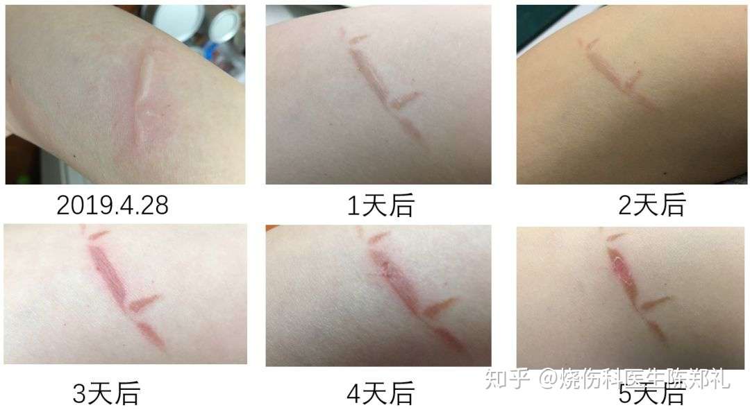 伤口本来已经好转了 为什么突然又痛了 知乎