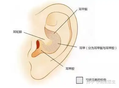 耳软骨取出后还会再长吗?还能戴耳机,打耳洞吗?