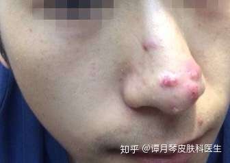 危险三角区长痘痘不要挤正确处理的方案是这样的