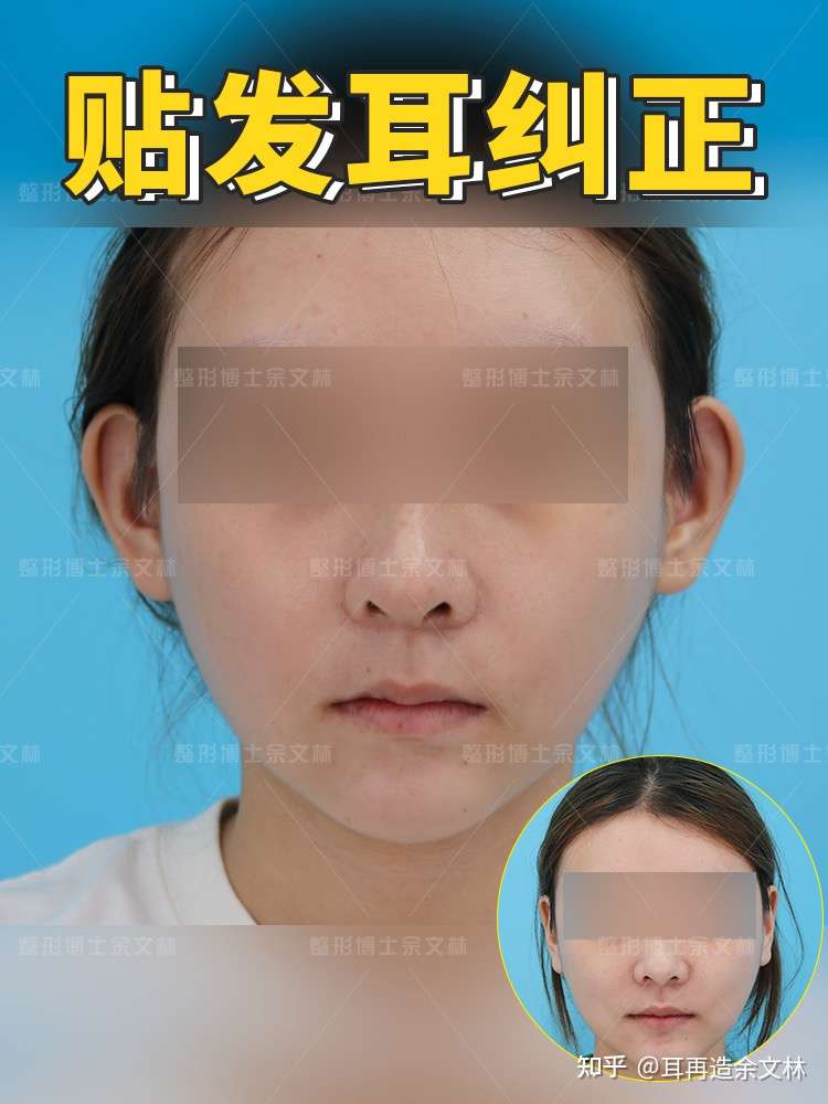 贴发耳矫正案例分享60