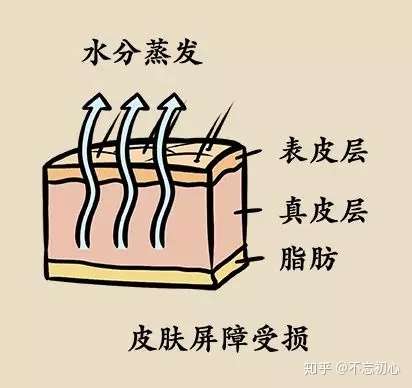 皮肤屏障受损,天然保湿因子(nmf)流失,水分蒸发过多,一些皮肤敏感的