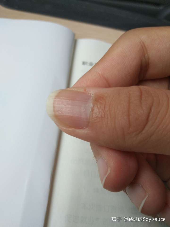 手指甲有凹凸不平是什么情况