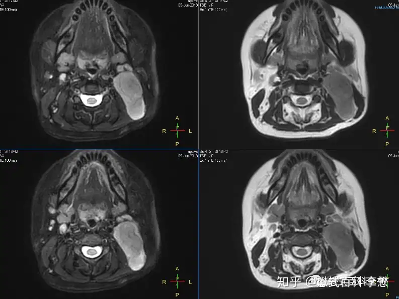 磁共振鼻咽、颈部规扫描规范及技术应用（一） - 知乎