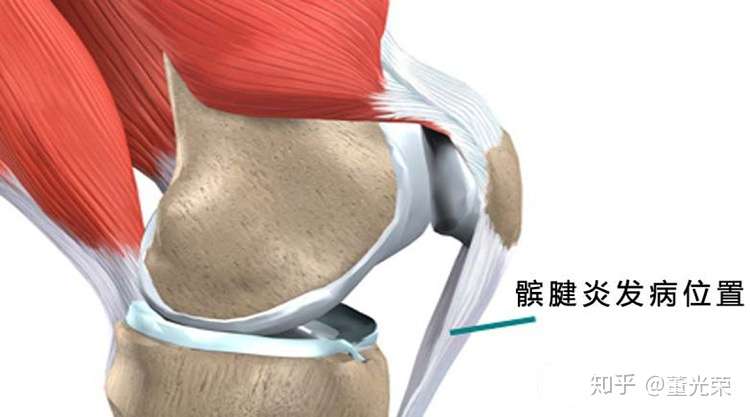 膝关节常见损伤 膝盖下方疼痛 请对症治疗 知乎