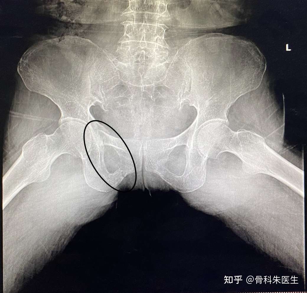 摔倒后的 不仅仅股骨头股骨颈容易骨折 还有一种很常见 知乎