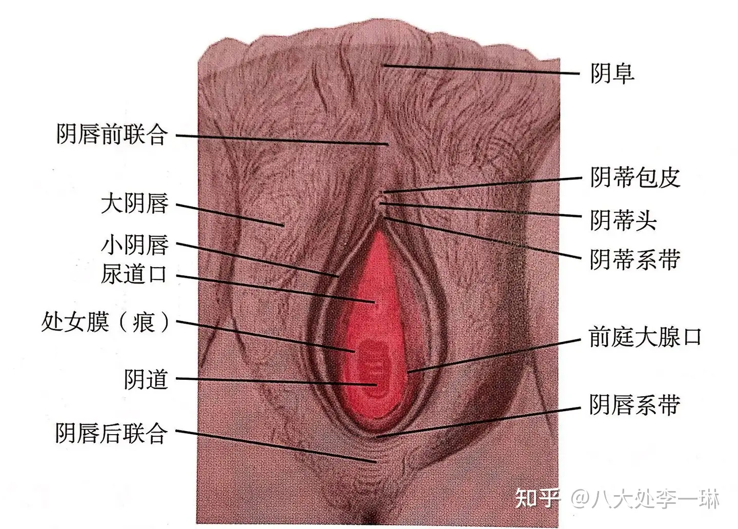阴蒂肥大