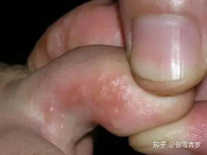 脚气水泡痒千万别弄破这样做才对