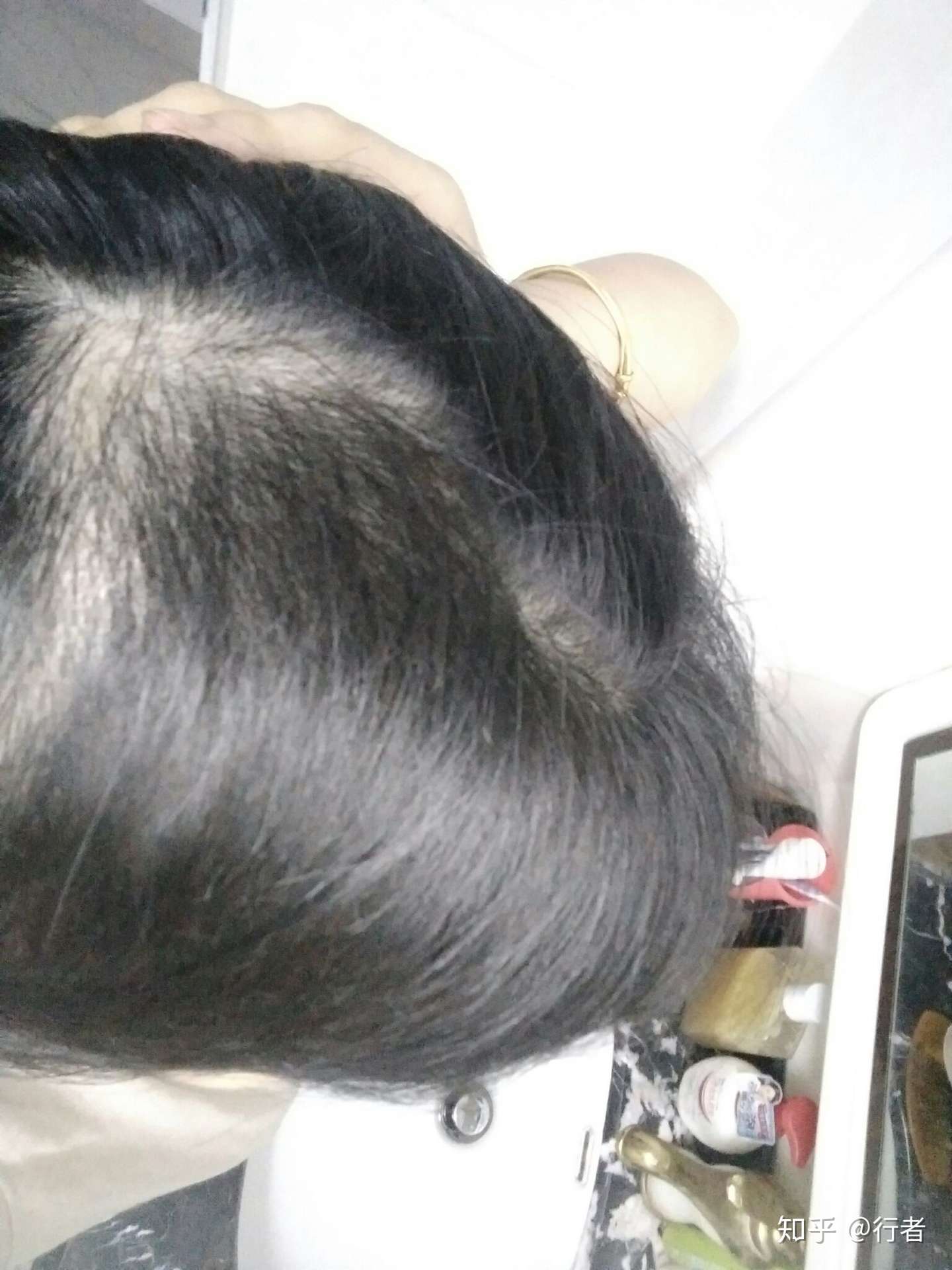 拔毛癖的自救之路 知乎