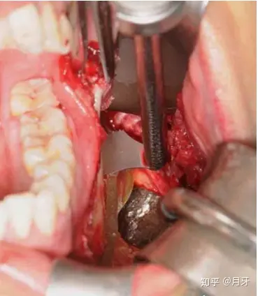 术中操作,沿导板截骨沿导板切下来的下颌角虚拟手术和真实手术匹配度
