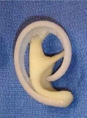 为什么很多医院很少用曼特波人工骨做下巴曼特波假体价格是不是膨体要