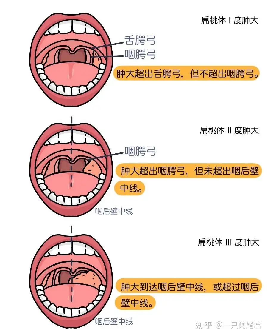 口蓋咽頭弓