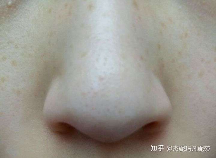 脸部鼻子皮肤鸡皮(鼻子两侧眼下鸡皮肤) 脸部鼻子皮肤鸡皮(鼻子两侧眼下鸡皮肤)