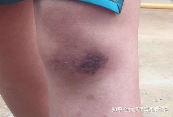 小腿摔伤后疤痕变黑是咋回事 知乎