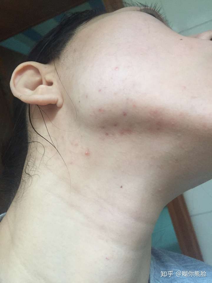 下巴和脖子交界处总长痘痘是什么原因该怎么办
