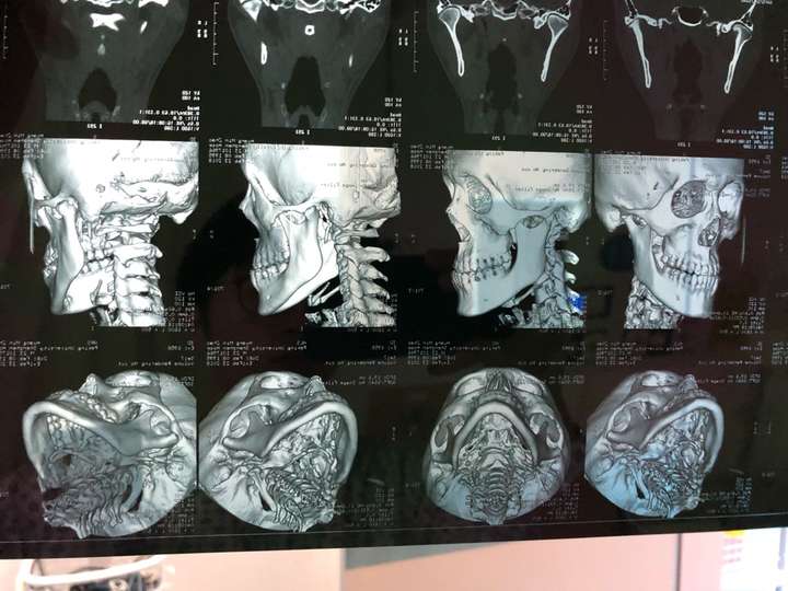 23岁骨性地包天 去医院拍了片做了牙模 医生说很难做 想知道我这种