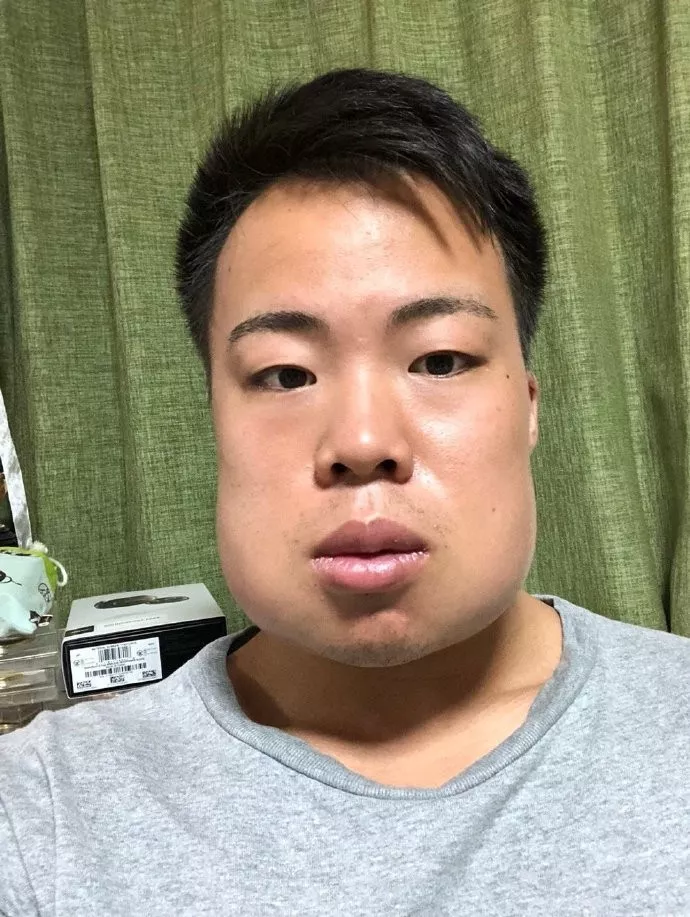 拔智齿会改变脸型吗?