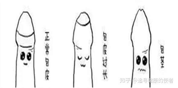 男性 包皮过长 到底需不需要手术 知乎