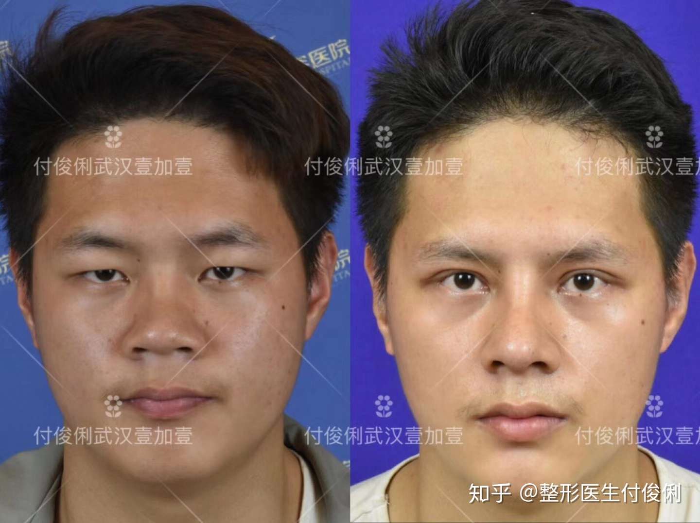 男性隆鼻和女性隆鼻有什么区别吗 知乎