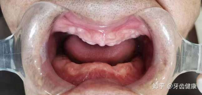 人老就一定会掉牙老掉牙真不是年龄的错