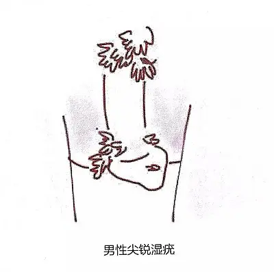 男性hpv感染后会患什么病派特灵伊可尔官方科普