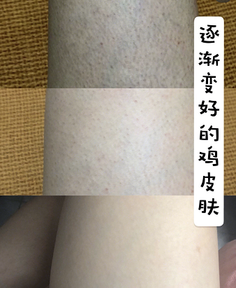 鸡皮肤治不好也改善不好(鸡皮肤治不好也改善不好怎么办)