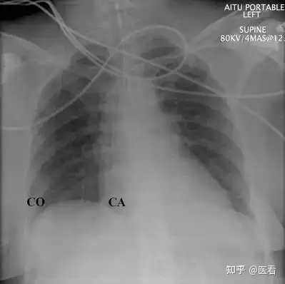 圖 2:正常仰臥位胸片顯示出了心膈角 (ca) 和肋膈角 (co)處於立位時