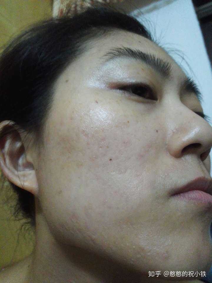 有什么办法能让痘印消失