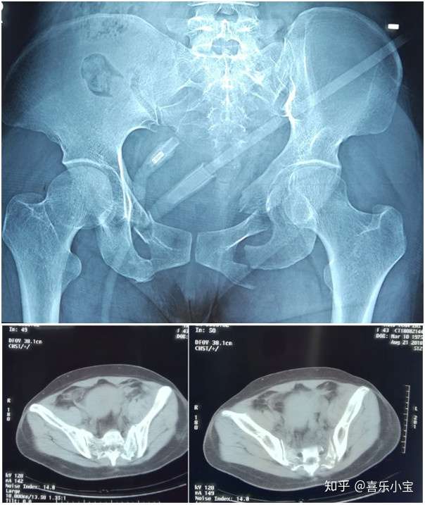 西南医大附院蓝田分院骨盆骨折也可以 微创 了 知乎