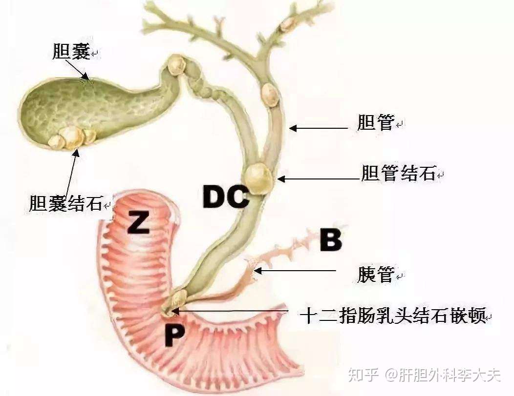 胆囊的功能有哪些 切了胆囊就不能吃肉了吗 知乎