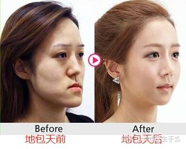 给婴儿喂奶,或者让孩子拿着奶瓶平躺吸奶,造成孩子下颌用力,引起反颌