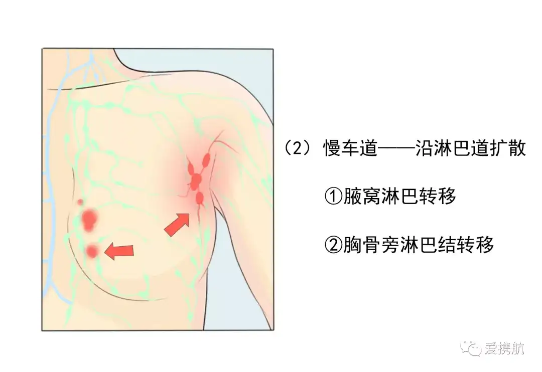 乳腺癌科普 乳腺癌需要谈癌色变么 Cacakp 抗癌协会科普防治平台