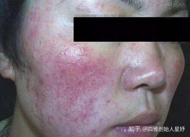 拿什么拯救你可怕的铅汞斑