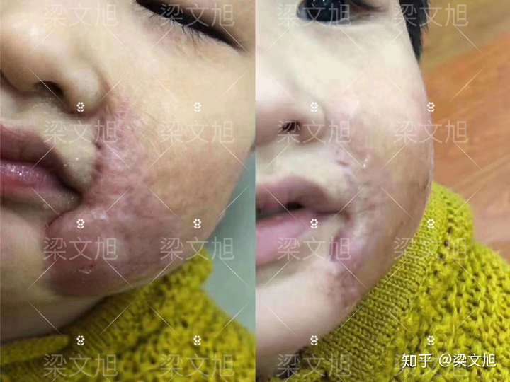 重组人表皮生长因子凝胶可以治疗烫伤疤痕吗?