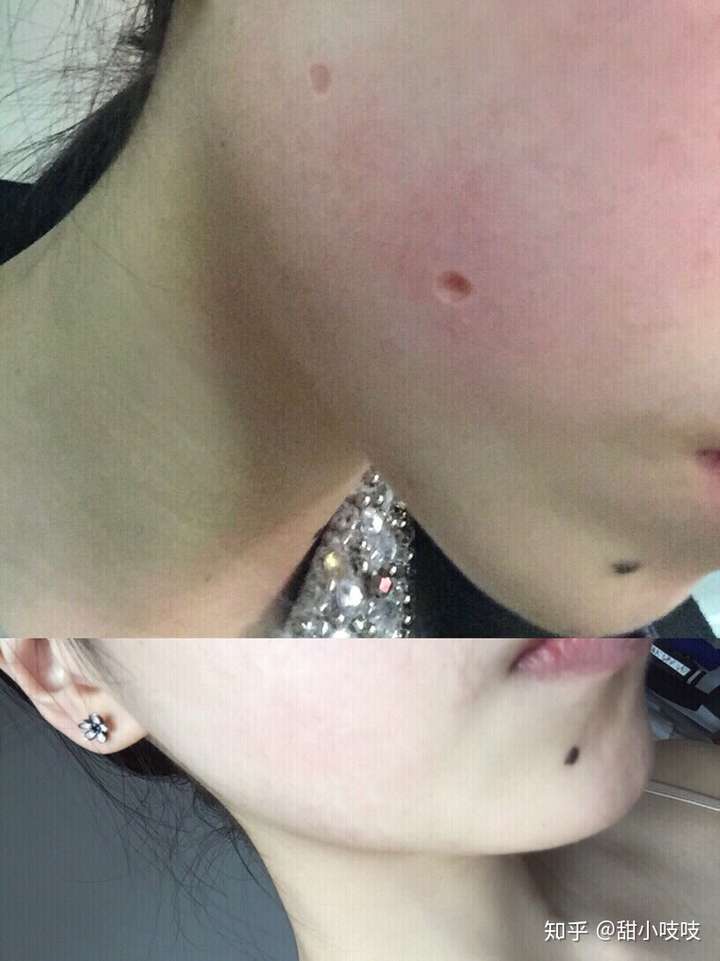 请问点痣结痂掉后需要擦什么吗