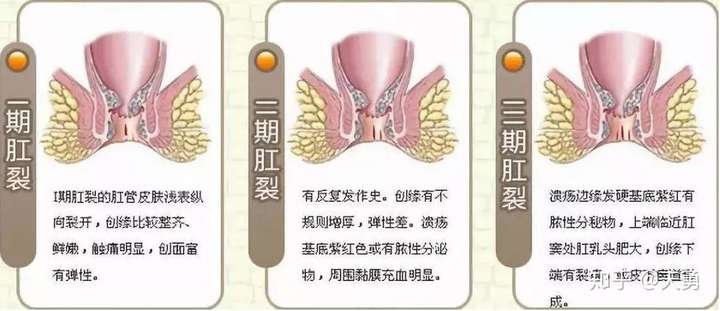 天勇|肛裂痛不欲生,要坐等自愈吗?