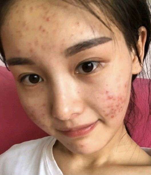 额头上长痘痘是什么原因造成的怎么才可以消除呢