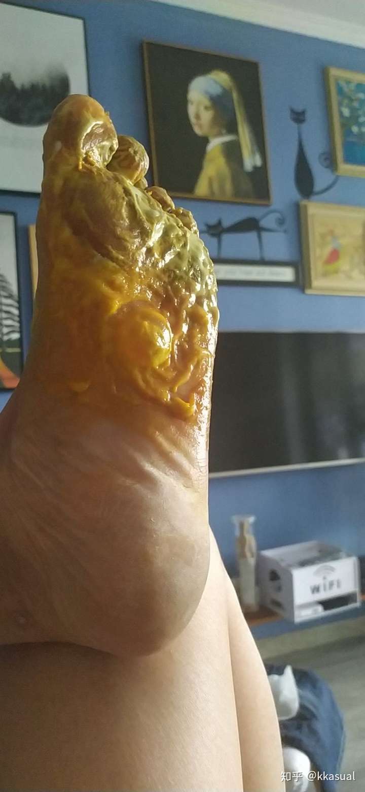 求救脚气已经这样了还有的救么有图慎点