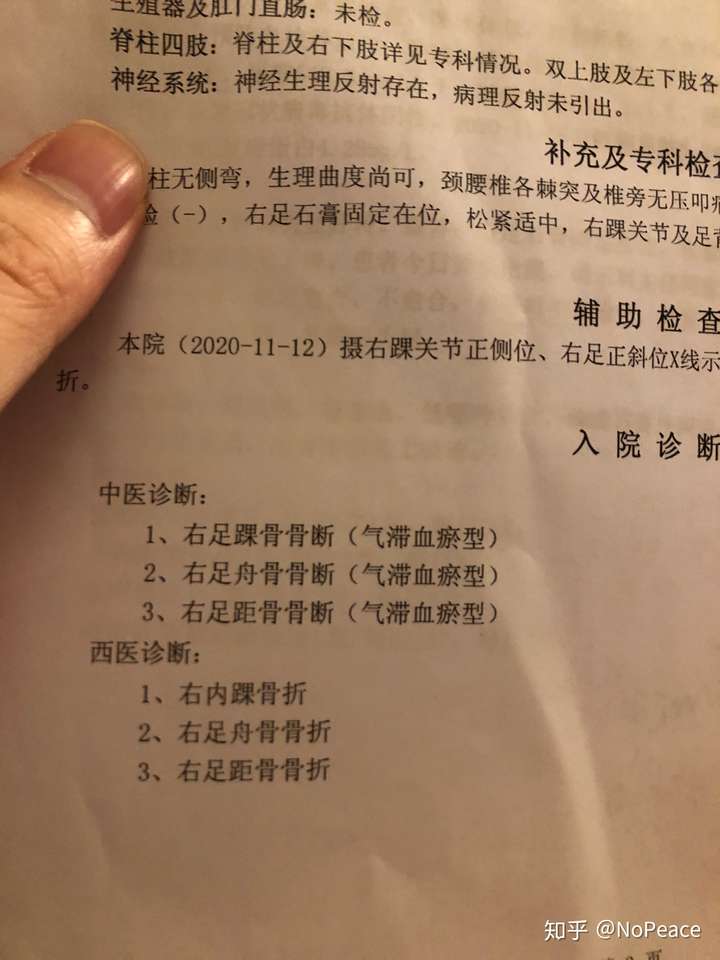 記右內踝骨折右足舟骨右足距骨撕脫性骨折