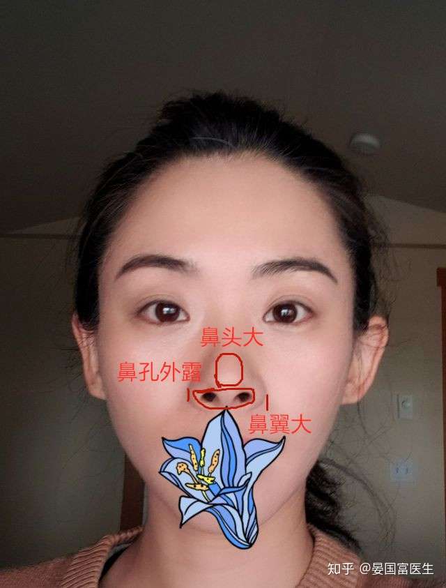 这样的鼻子只做鼻翼缩小可以吗
