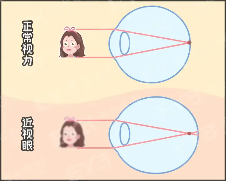 【眼健康科普课堂】为什么砸多少钱都治不好近视？(图5)