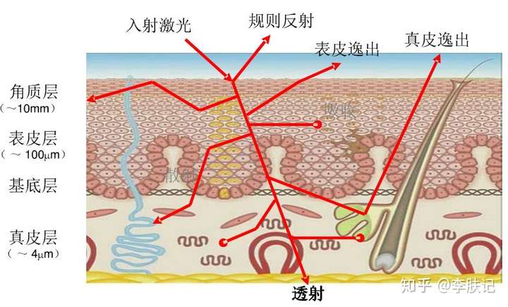 依据选择性光热作用原理,能"靶向治疗色素"对患者的皮肤发挥改善作用