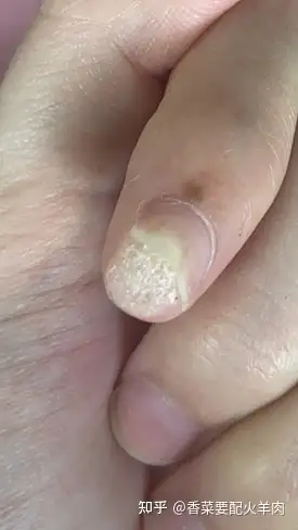 手指甲长疣 - 知乎