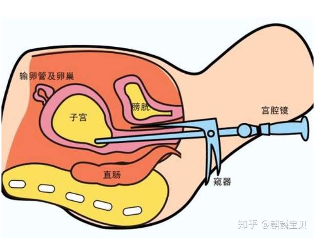 做试管必须要做宫腔镜吗?插图(2) v2-7489bd65b31f1244d09c9ccb59db729a_720w.jpg插图(2)