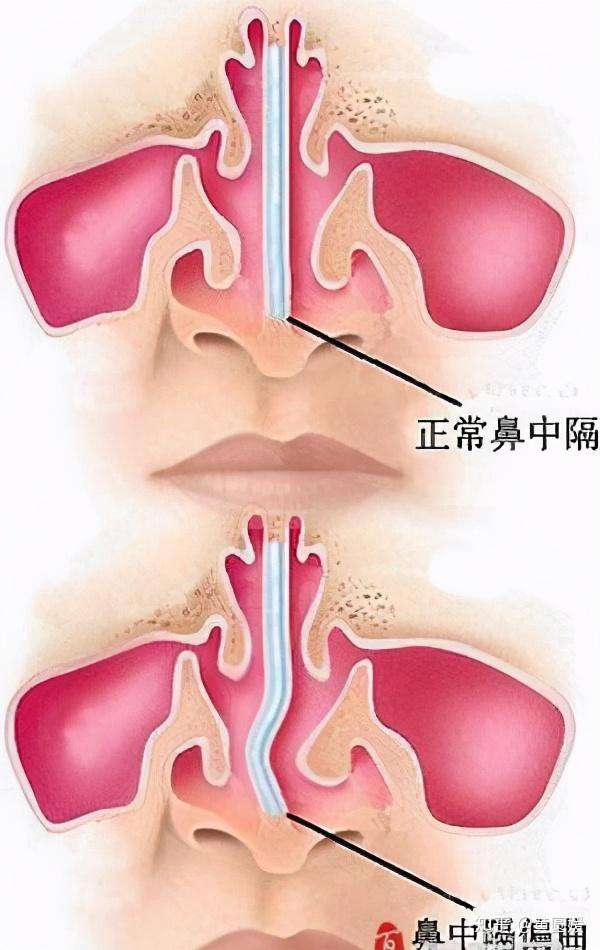 正常人鼻孔内部图片图片