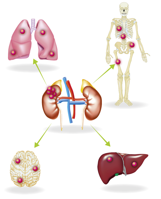 肾癌转移脏器的发生率 在转移性肾癌的患者中,按照转移率从高到底排序