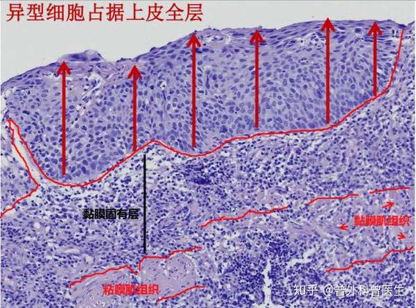 上皮内瘤变到底是不是癌 应该怎么治疗 来看看医生的回答 知乎